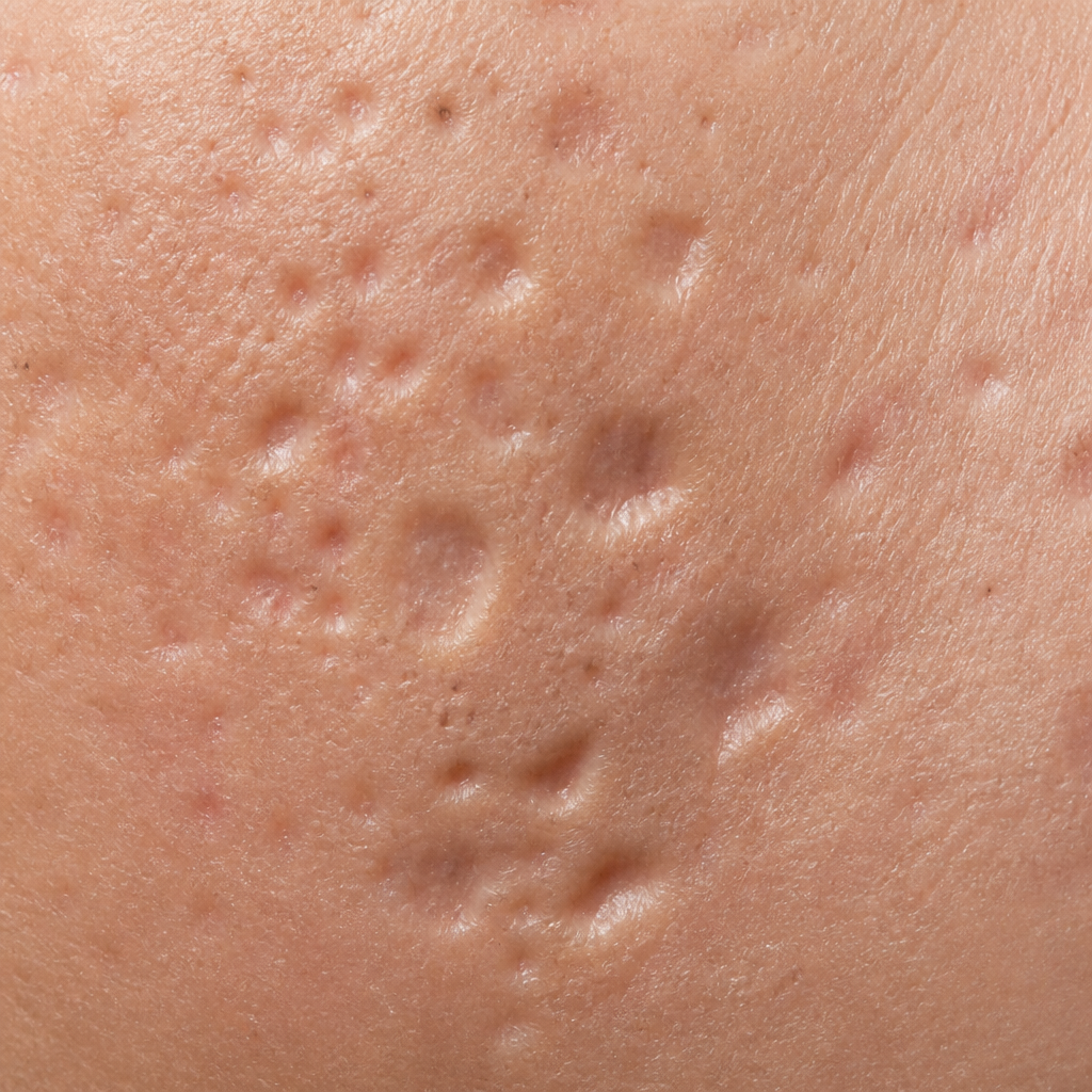 Macro close-up showing different acne scar types and skin texture patterns