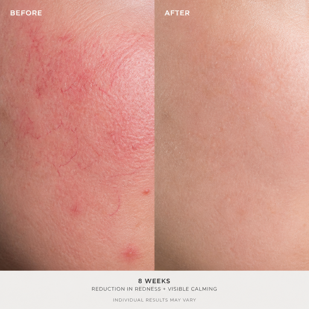 Before and after skin comparison showing improvement in redness and rosacea appearance